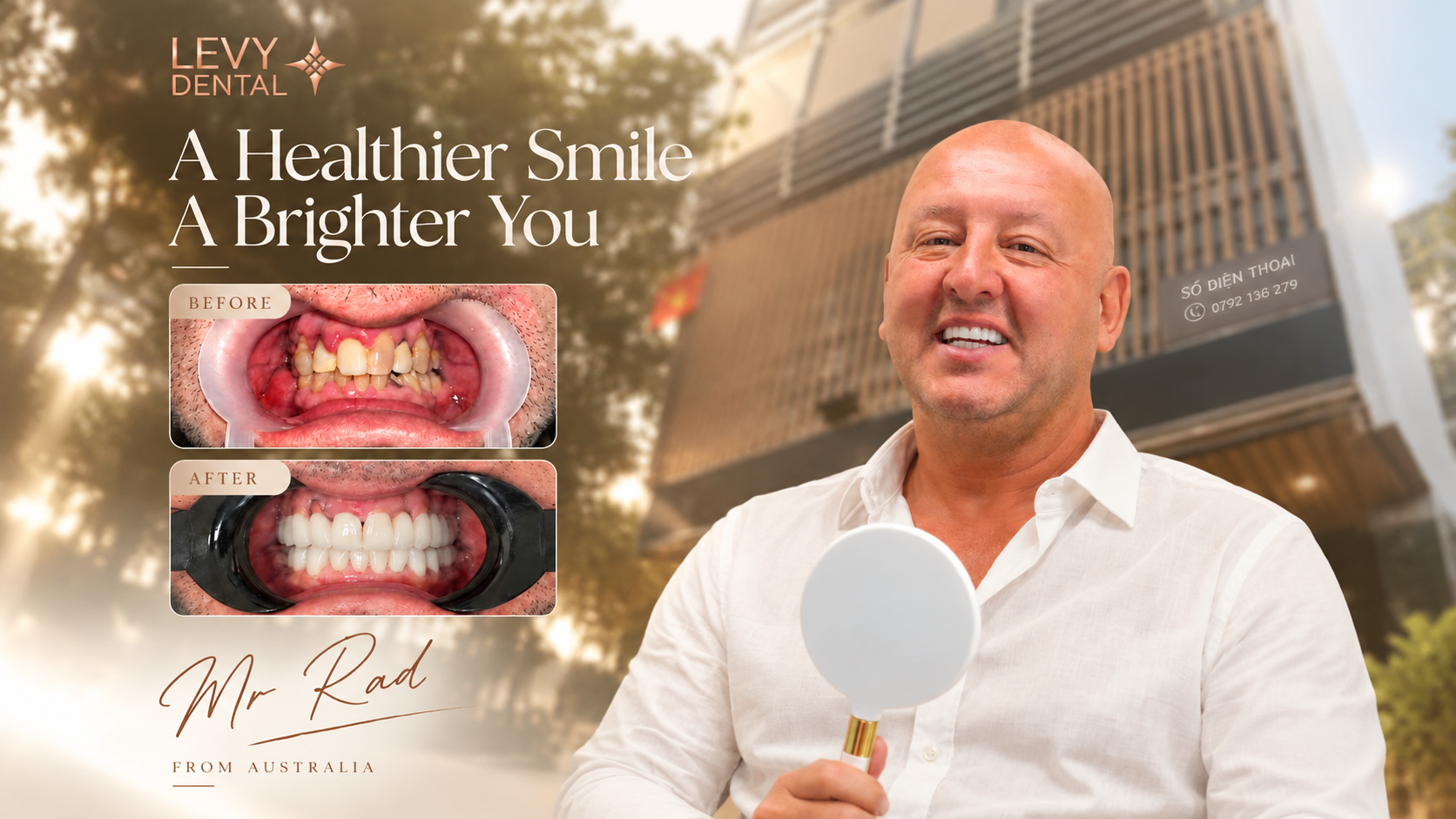 Ca phục hồi răng toàn diện với Implant và răng sứ tại Levy Dental Clinic