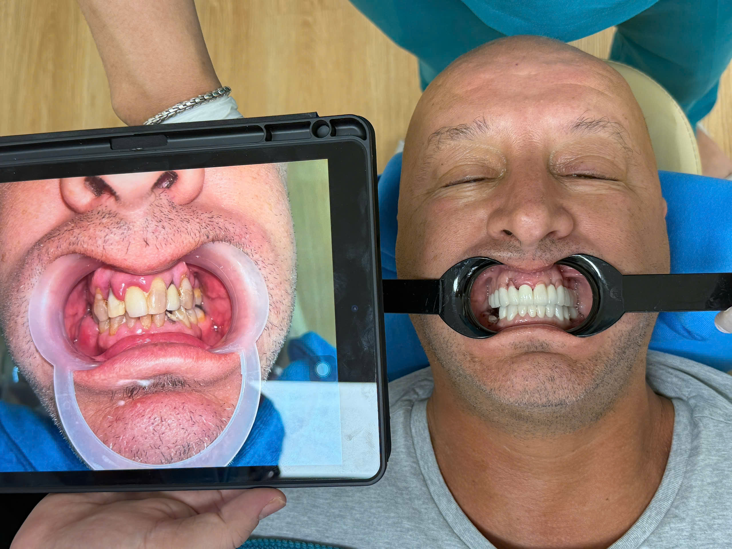 Thiết kế phục hình răng sứ Cercon kết hợp Implant tại Levy Dental Clinic