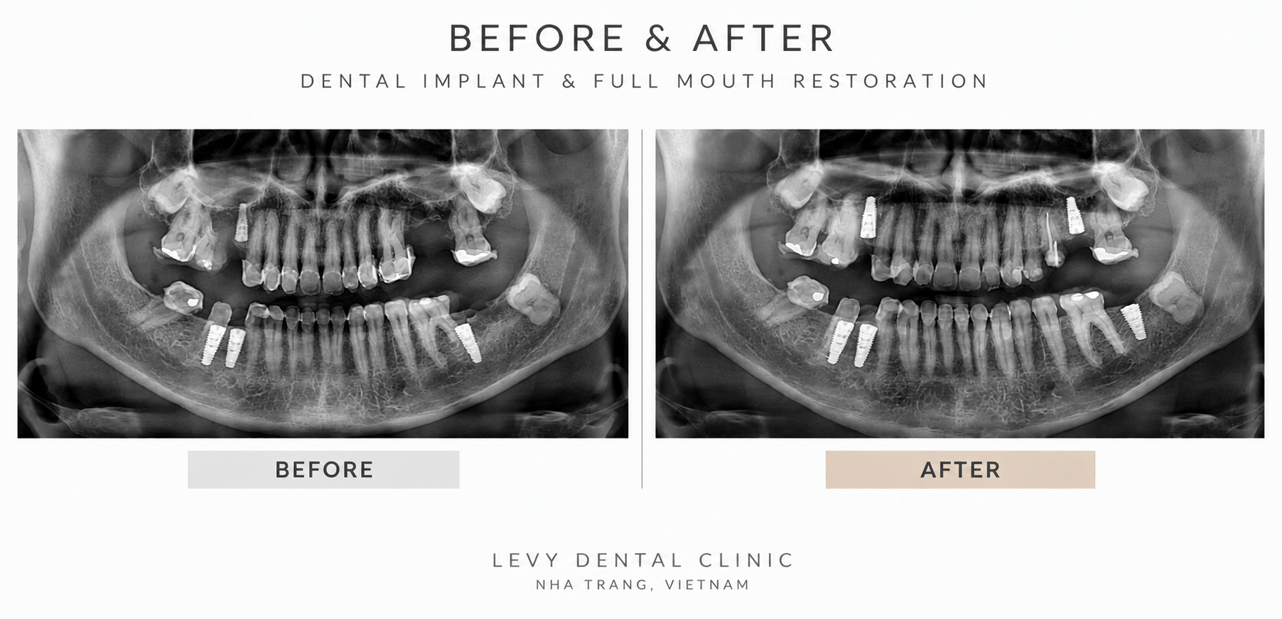 Sonia’s panoramic X-ray showing implant positions and final dental restoration results