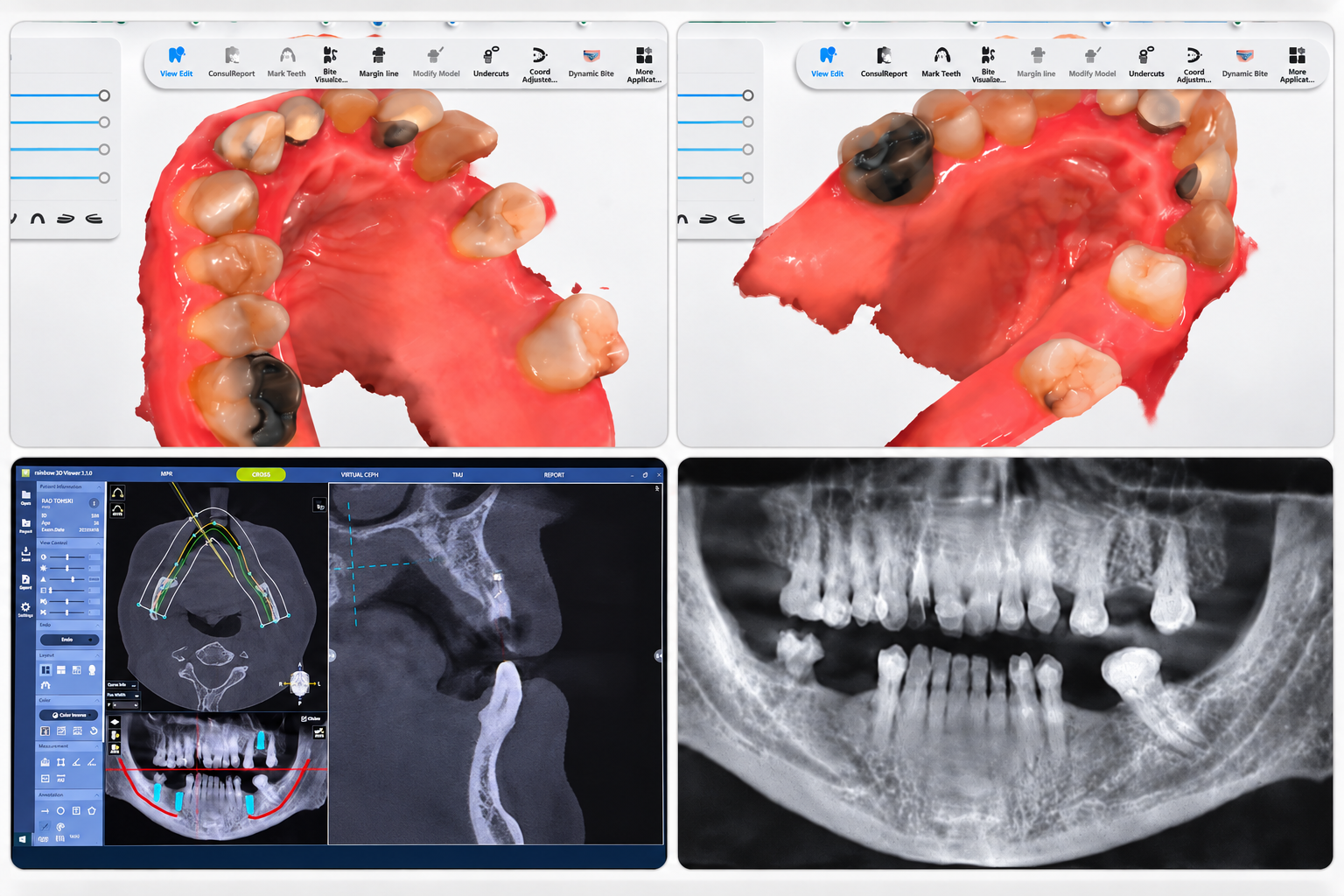 Bệnh nhân thực hiện kế hoạch phục hồi răng toàn diện tại Levy Dental Clinic Nha Trang